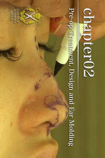 鼻尖形成術・耳介軟骨移植のスクリーンショット_1